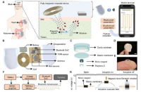 微型磁性植入物与可穿戴设备配合使用可实现无线健康监测